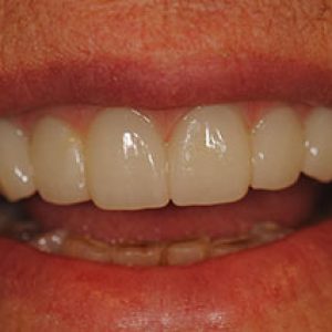 After Implant Denture - Smile Gallery