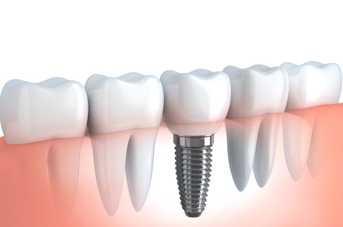 Dental Implants 2 – Billings, MT | Yellowstone Family Dental