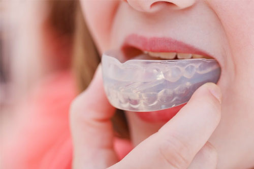 Mouthguards 2 – Billings, MT | Yellowstone Family Dental