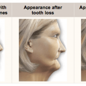 Tooth Loss and Bone Loss Appearances