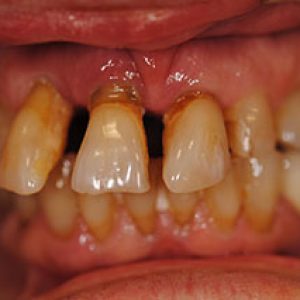 Before Implant Denture - Smile Gallery