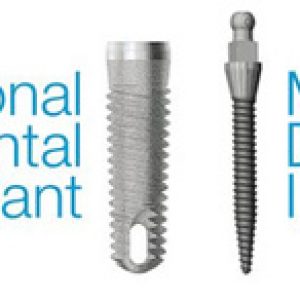 Traditional Dental Implants vs Mini Dental Implants | Yellowstone Family Dental