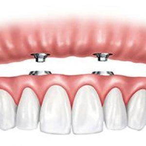 All-on-4 Dental Implants – Billings, MT | Yellowstone Family Dental
