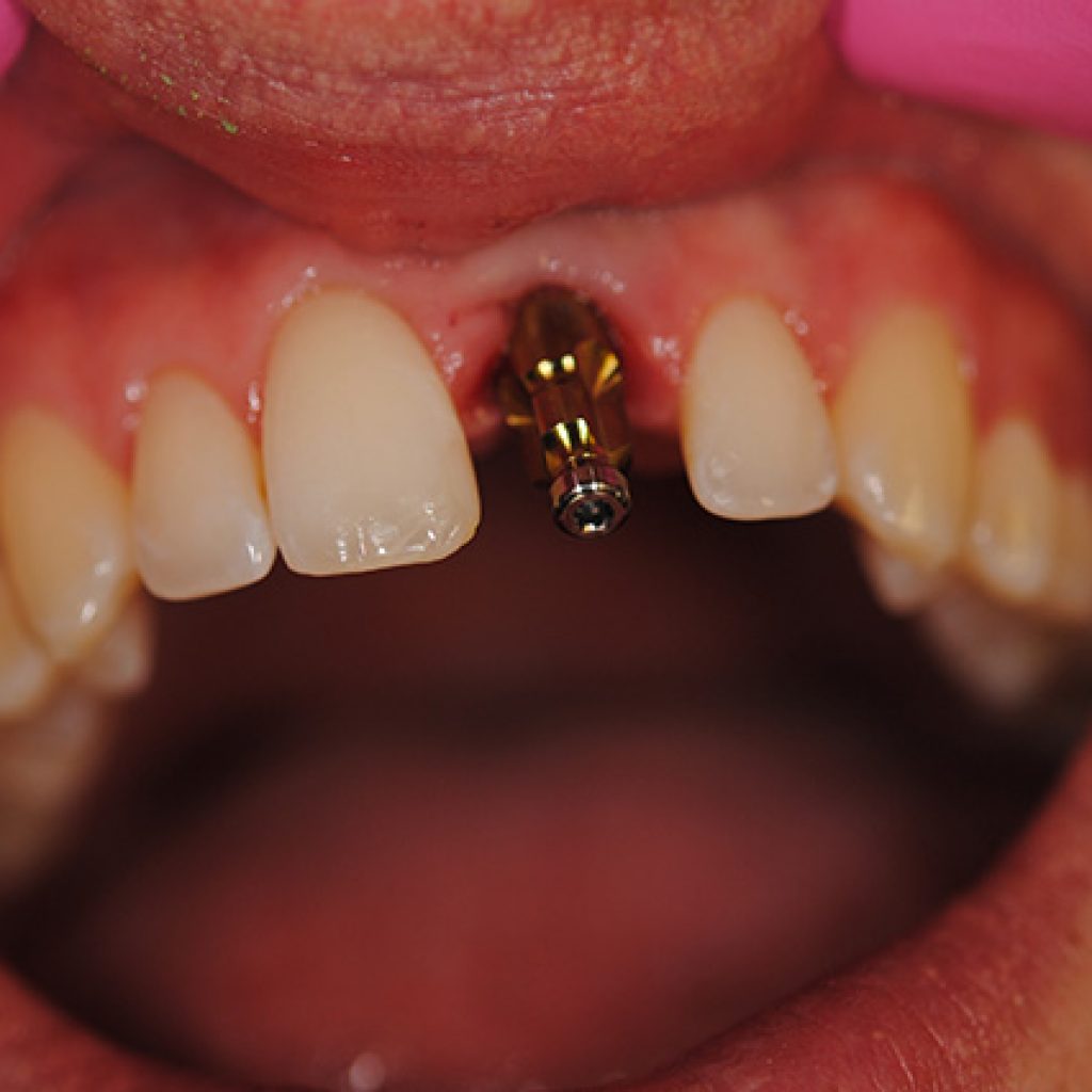 A Great Dental Implant Is One You Don’t Notice Billings, MT dentist